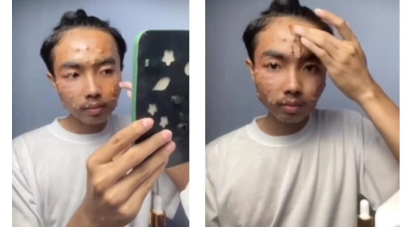 Man Develops Painful Skin Disease After Wearing Unwashed Thrifted Clothes