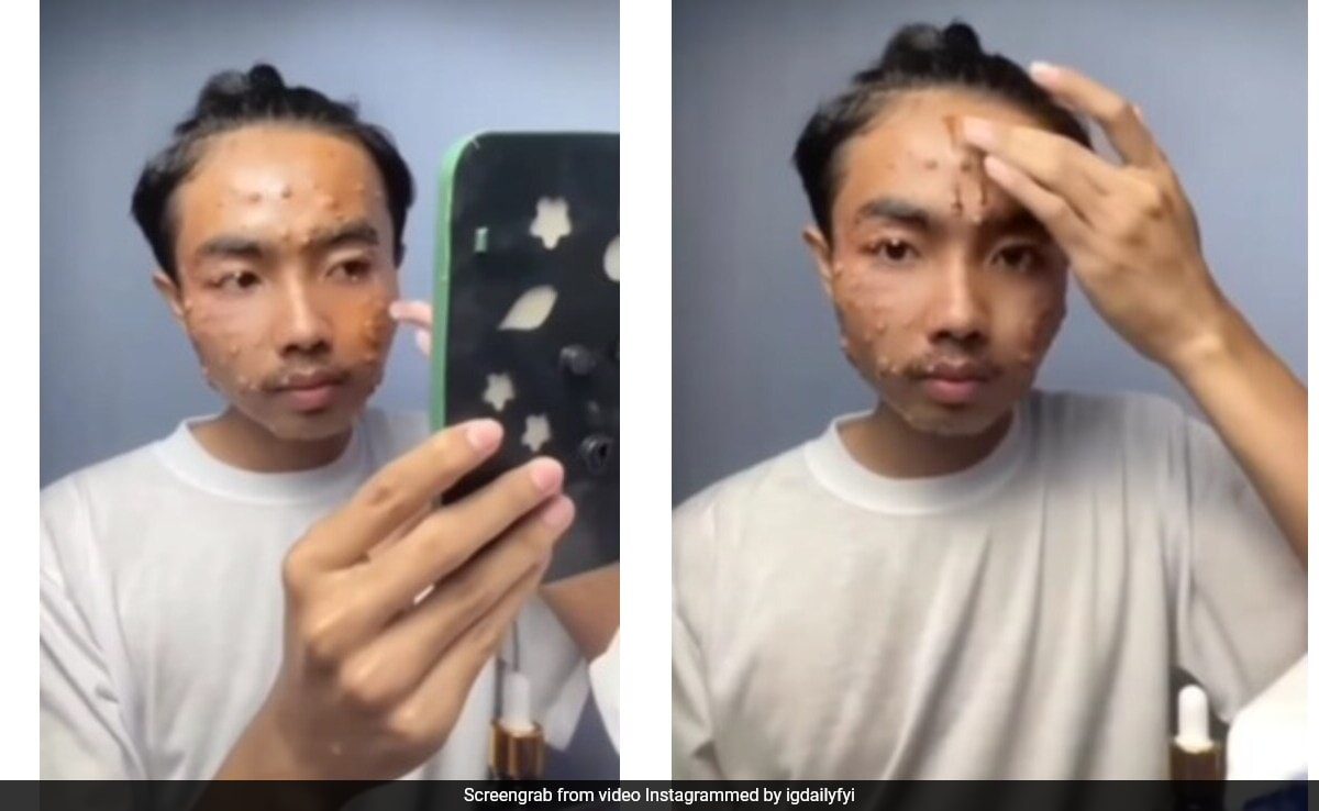 Man Develops Painful Skin Disease After Wearing Unwashed Thrifted Clothes