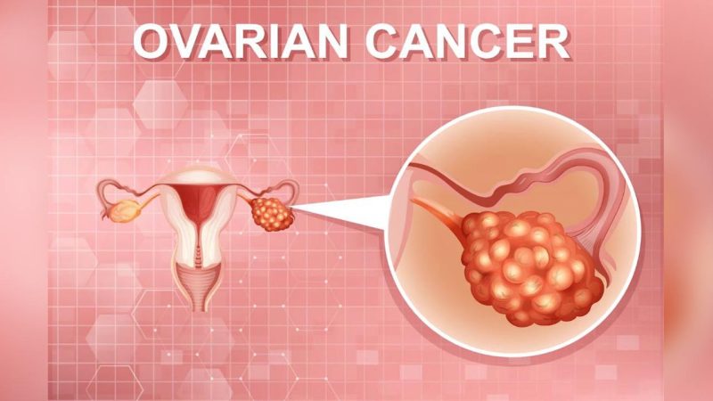 Ovarian Cancer: The overlooked threat among women’s cancers