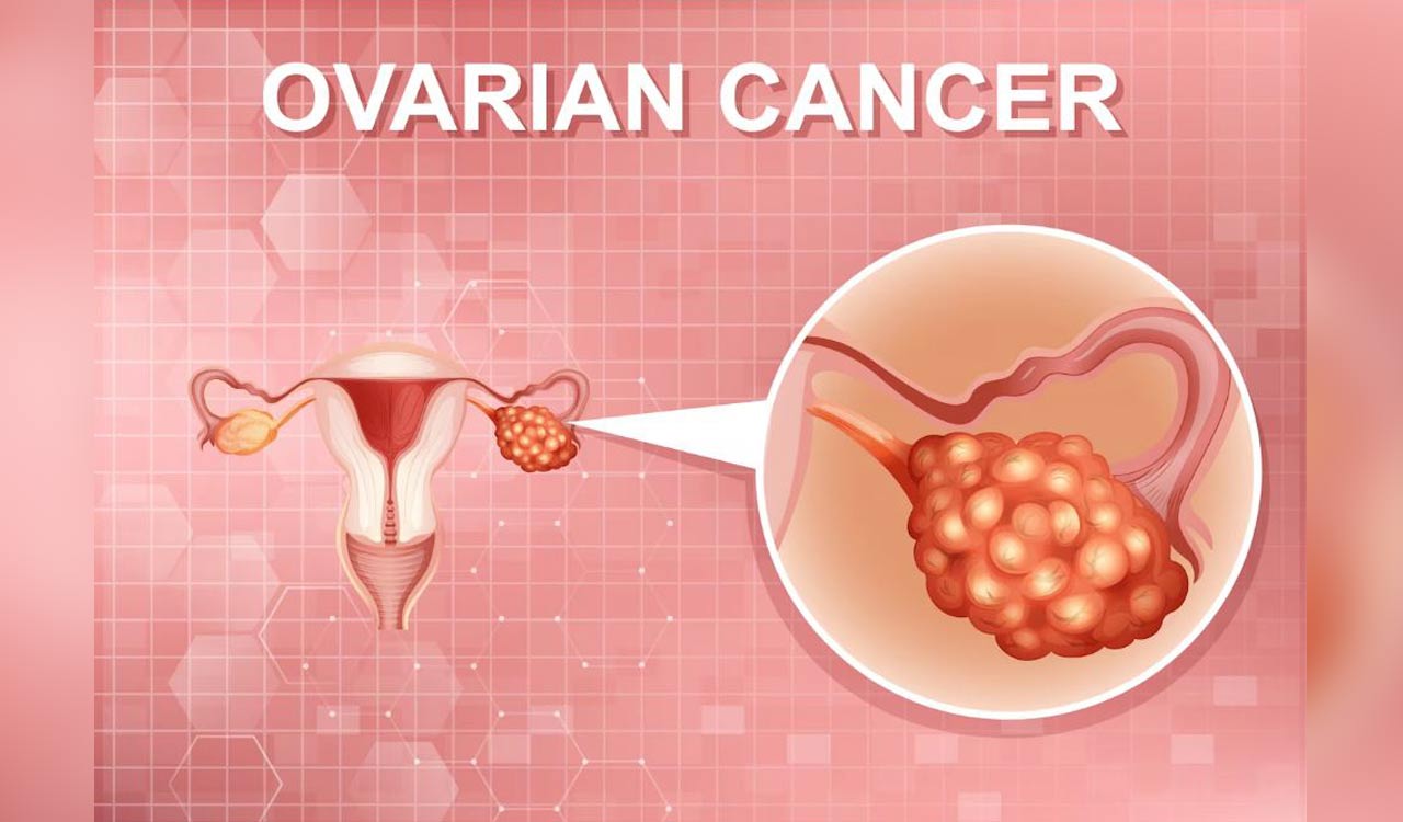 Ovarian Cancer: The overlooked threat among women’s cancers